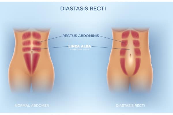 What Non-Surgical Options Are Available for Diastasis Recti Oxted?