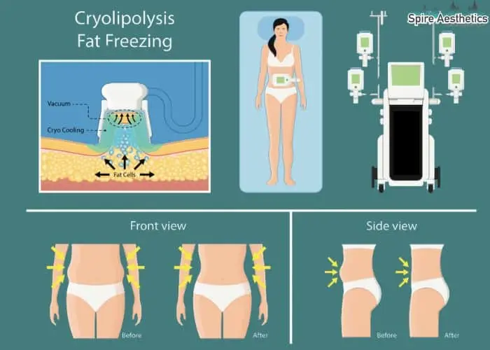 Fat freezing treatment Oxted benefits for competitions to remove stubborn fat deposits.