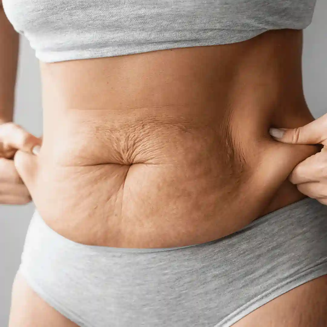 Is It Normal to Have Loose Skin After Pregnancy Oxted?