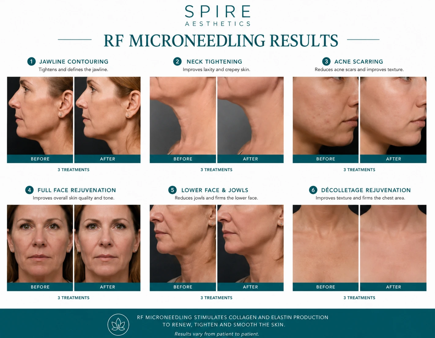 RF Microneedling Skin tightening Oxted results