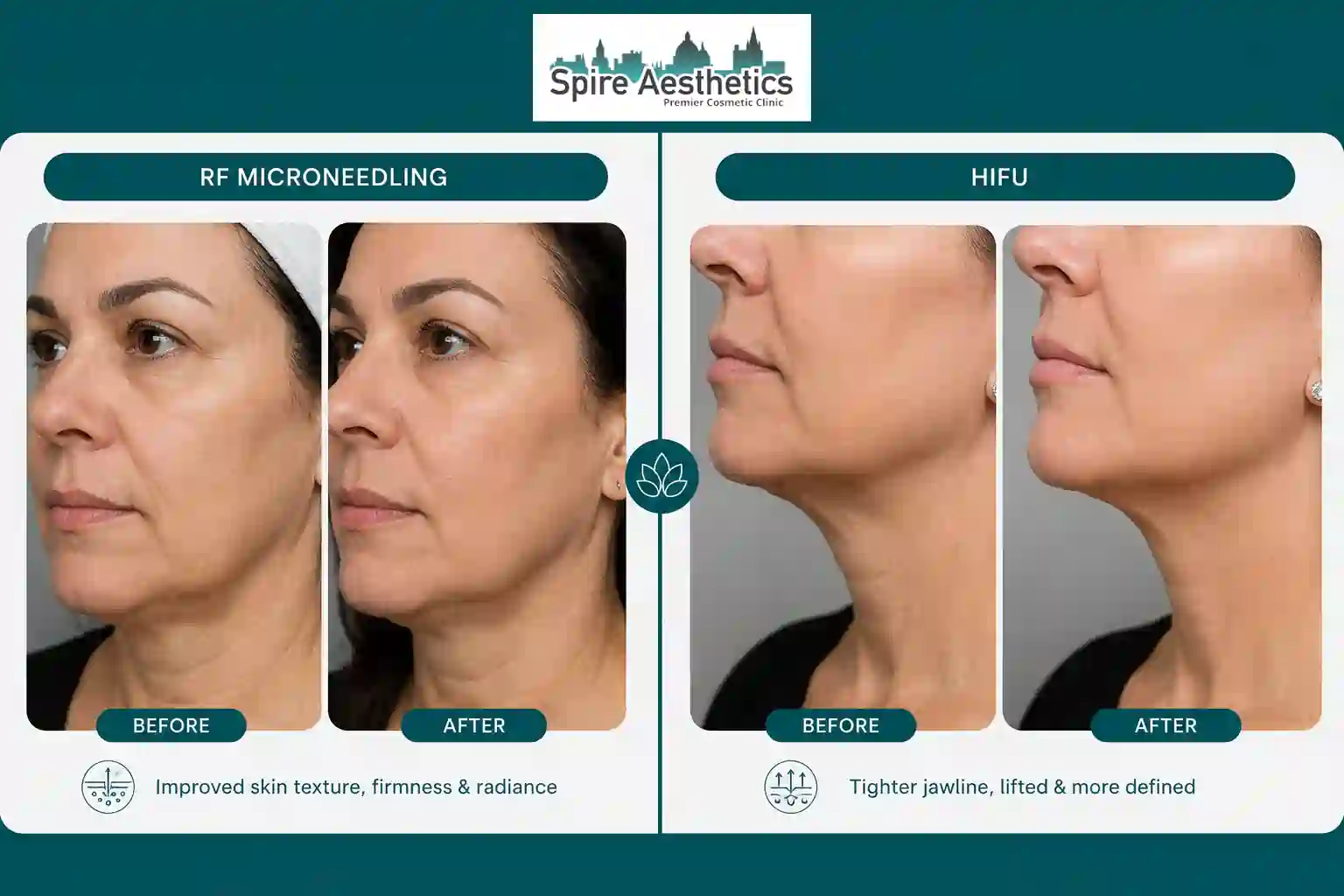 Can RF Microneedling and HIFU Be Combined Oxted?