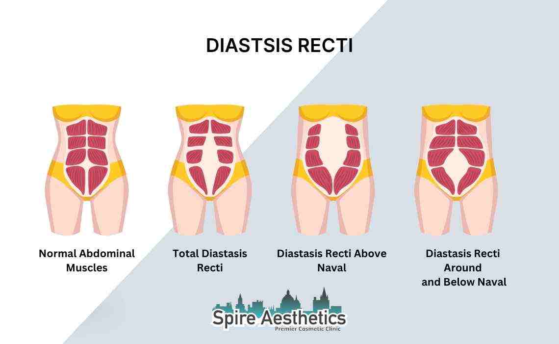 Is Non-Surgical Diastasis Recti Treatment Right for You? Common Concerns Answered Oxted